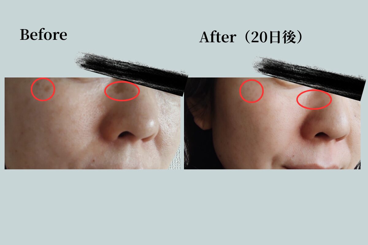 アラフィフ女性のシミ取りレーザー治療ビフォーアフター写真