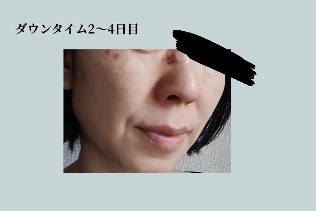 シミ取りダウンタイム中間経過