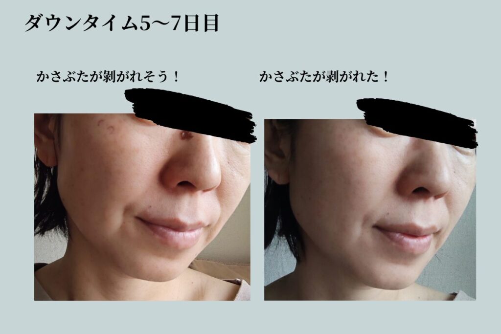 シミ取りダウンタイム最終経過