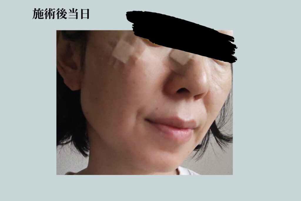 アラフィフ女性のシミ取りレーザー治療の写真